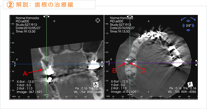 歯根の治療
