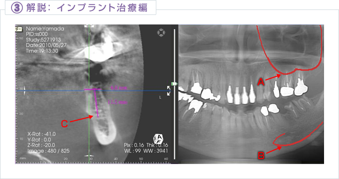 インプラント治療