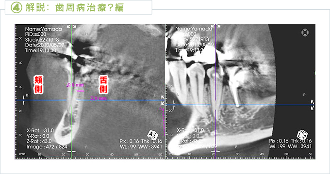 歯周病治療編